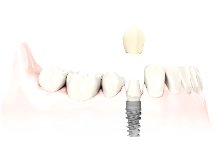 Legacy Dental Crown_abutment_implant